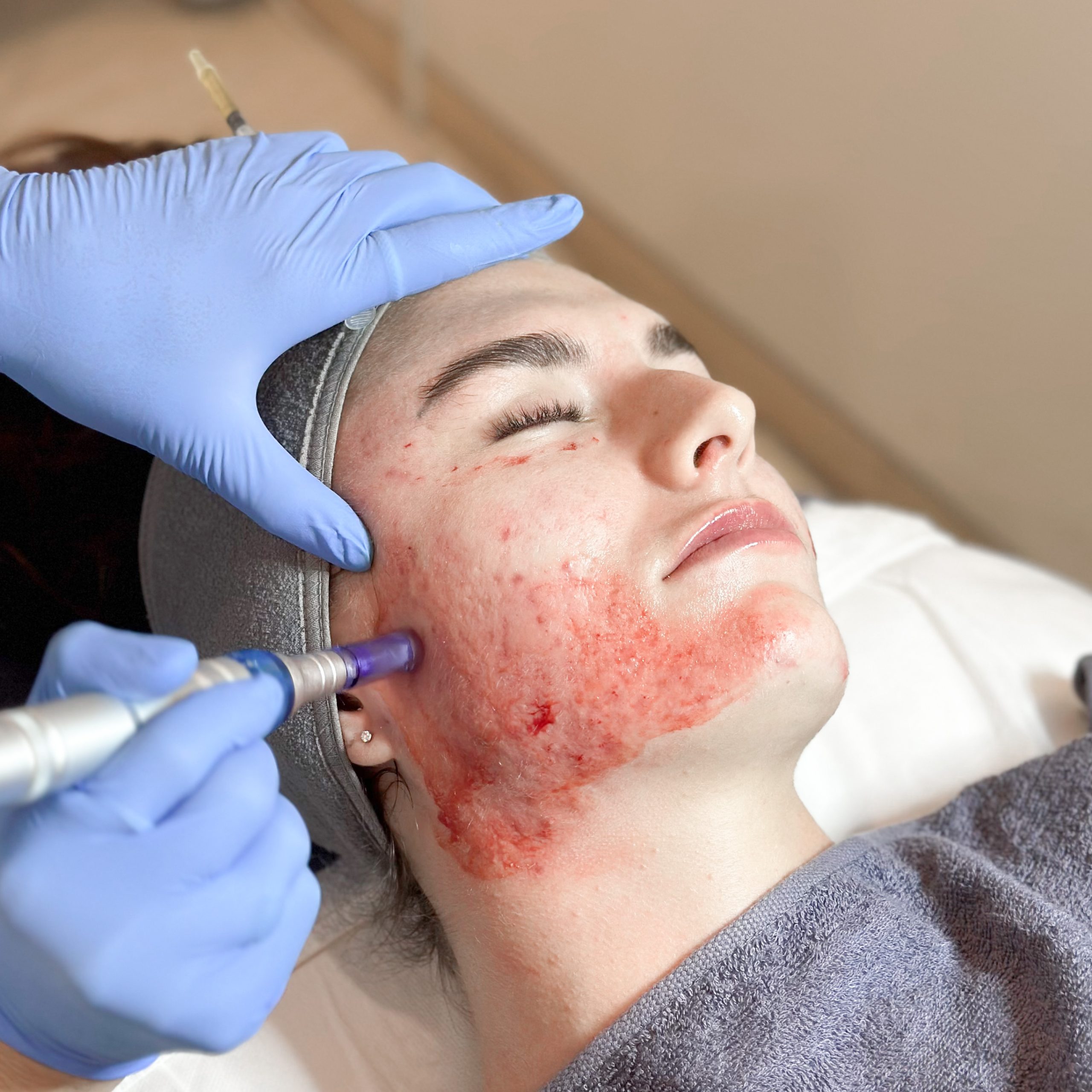 How PRP Therapy Boosts Hair Growth: A Complete Guide