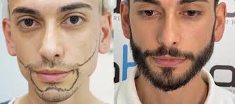 Beard Transplant