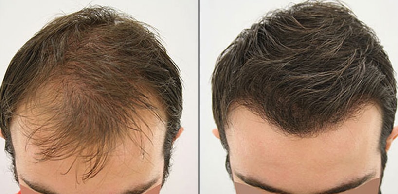 Long Hair Transplant