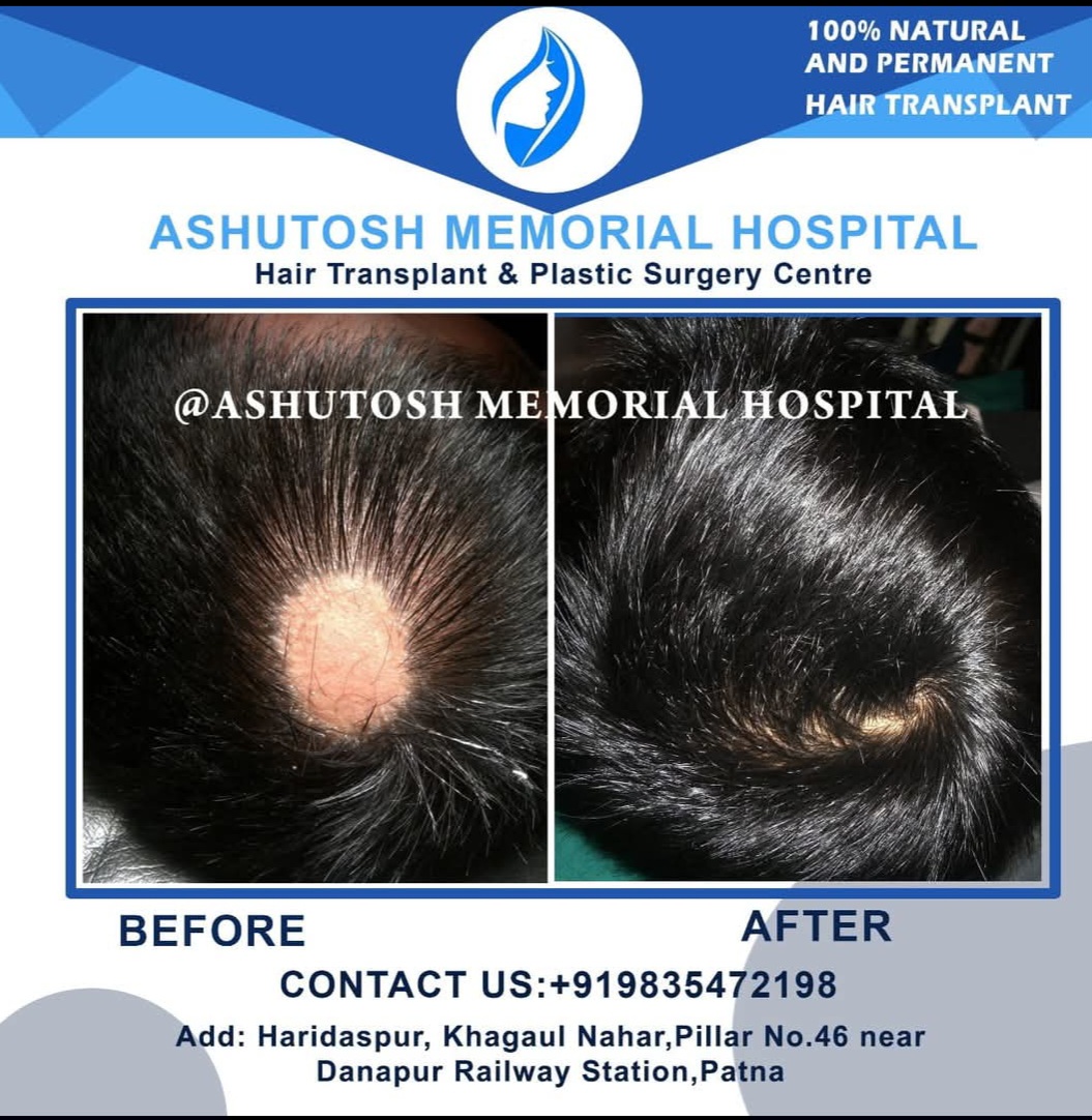 ALOPECIA AREATA