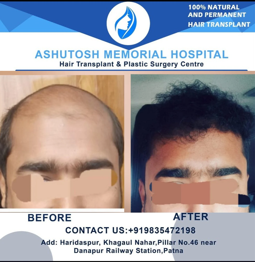 Fue hair transplant
