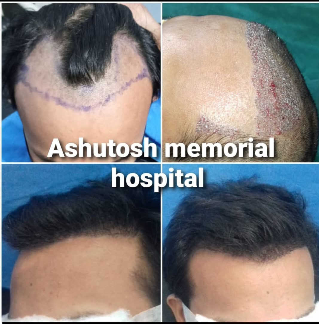 Fue hair transplant
