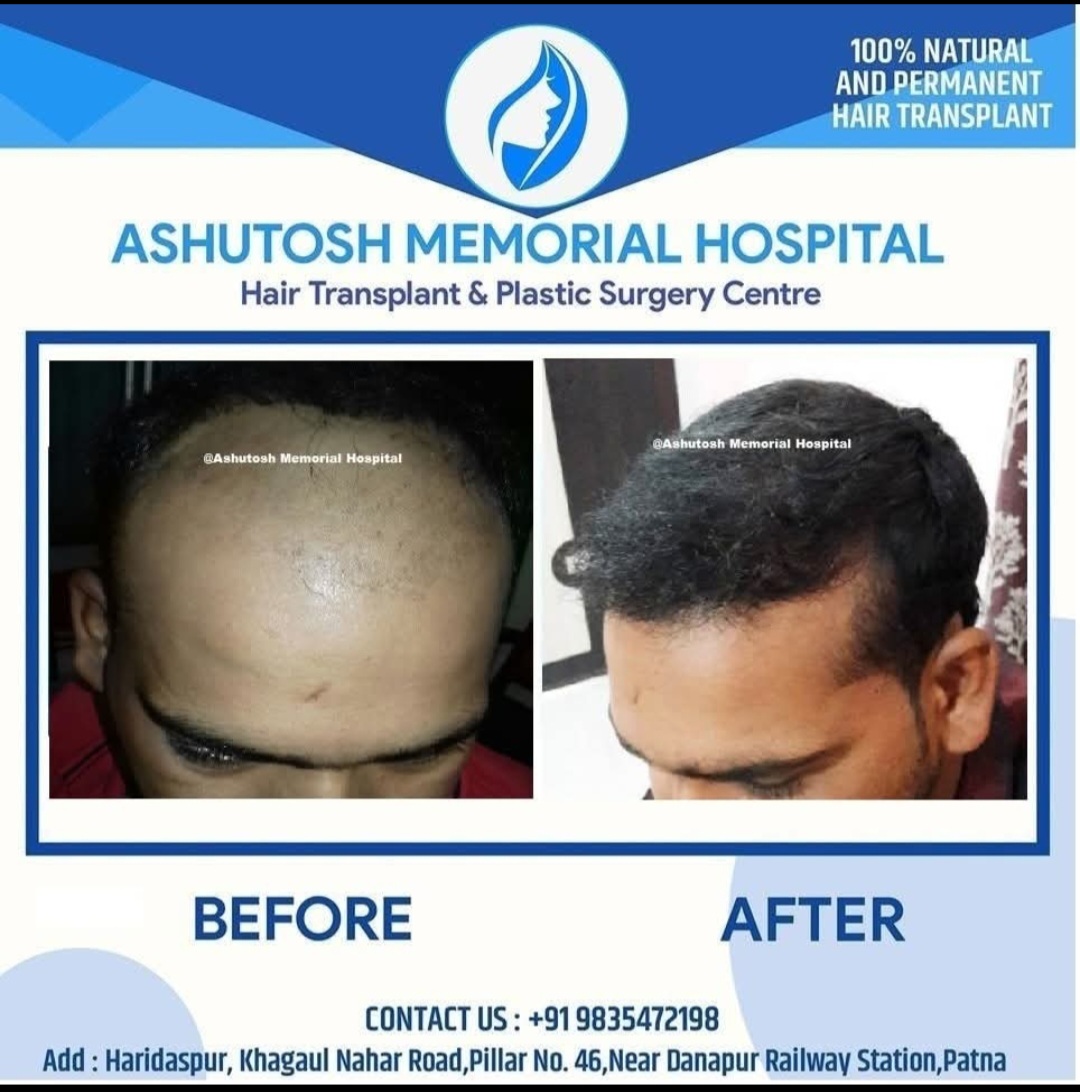 Fue hair transplant