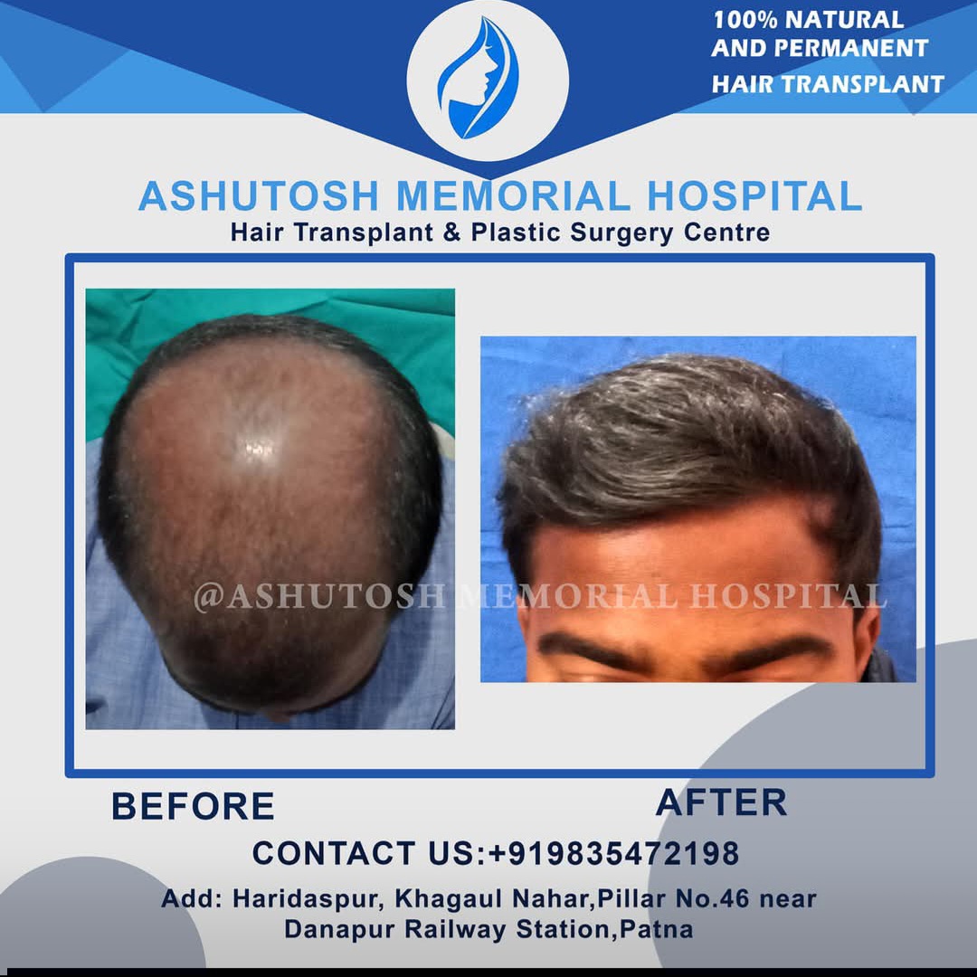 Fue hair transplant