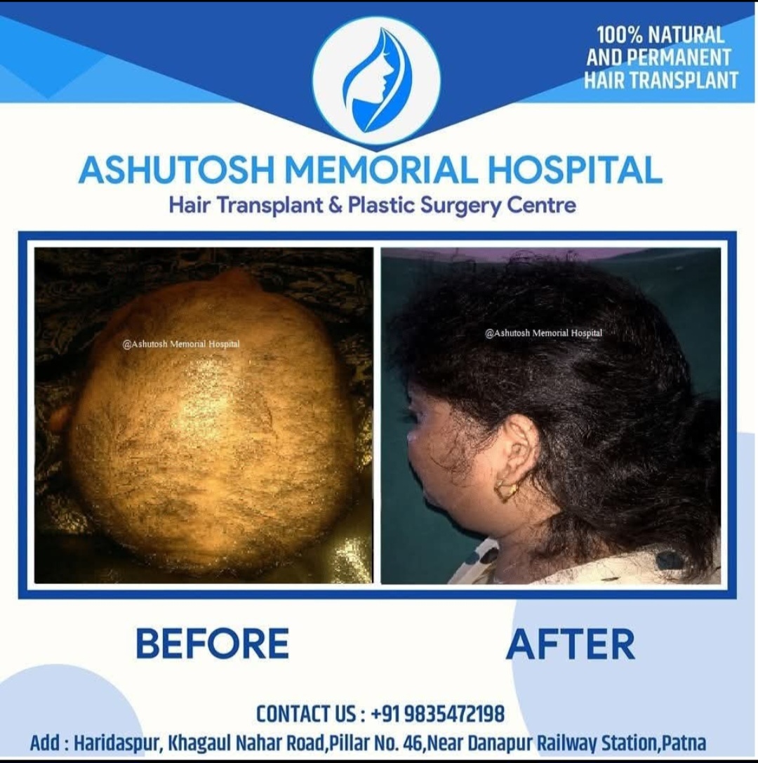 Trichotillomania