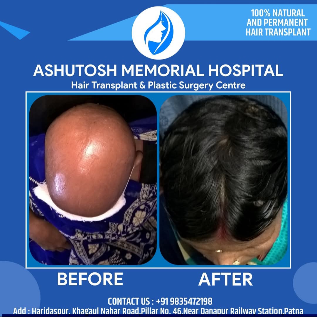 ALOPECIA universalis