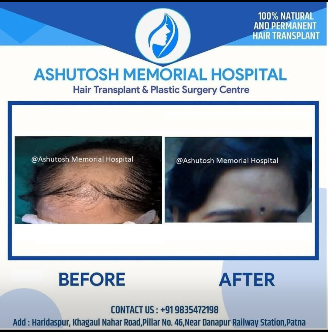 Fue hair transplant in female