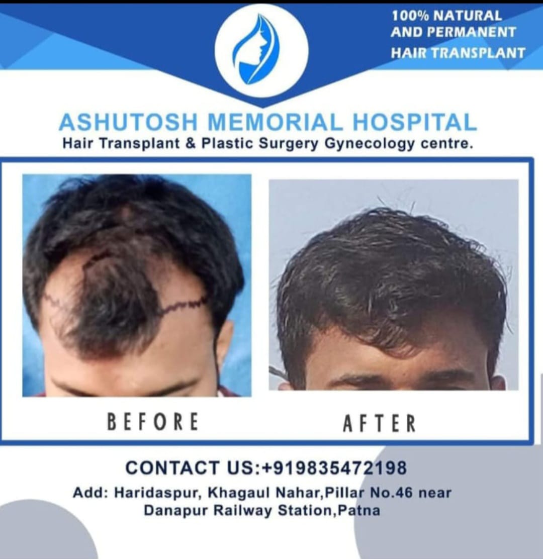 Fue hair transplant