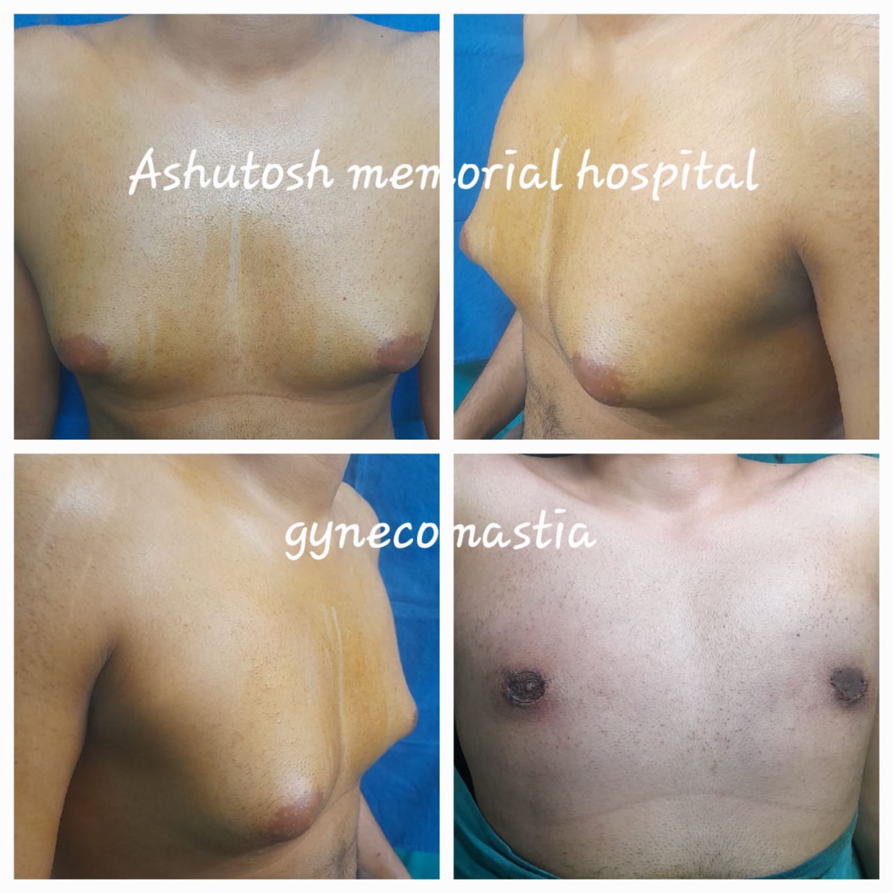 GYNECOMASTIA