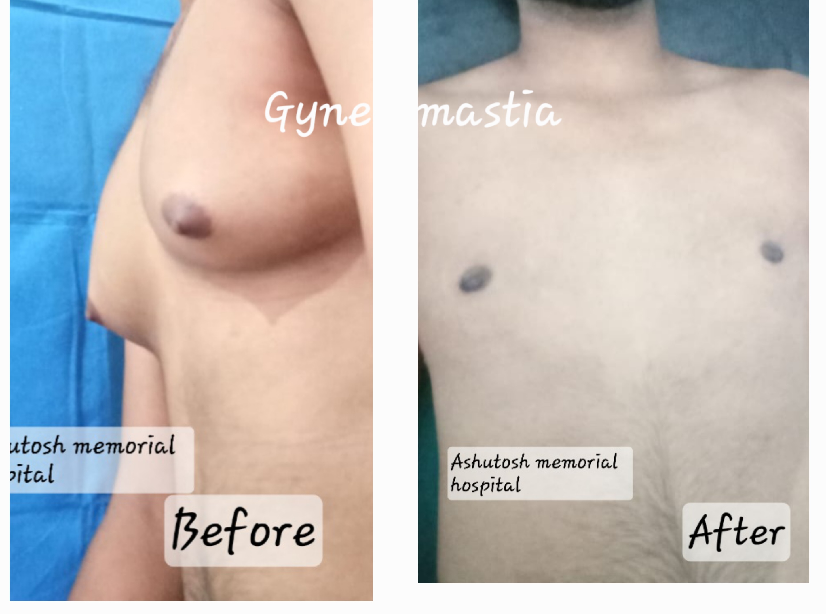 Gynecomastia