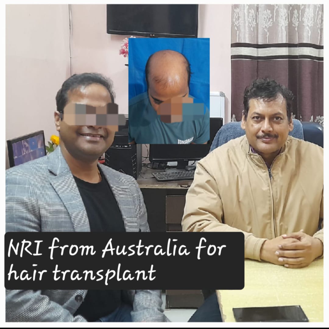 Fue hair transplant
