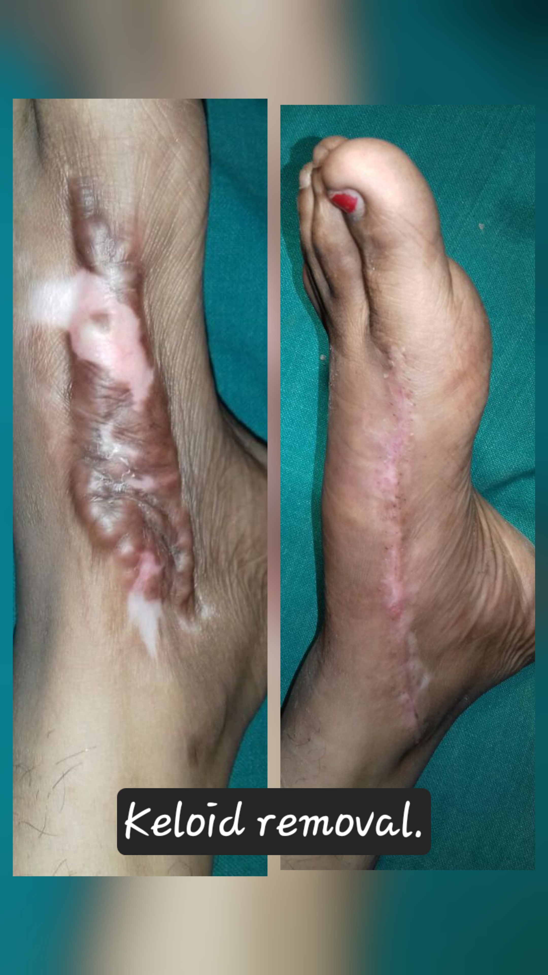 KELOID