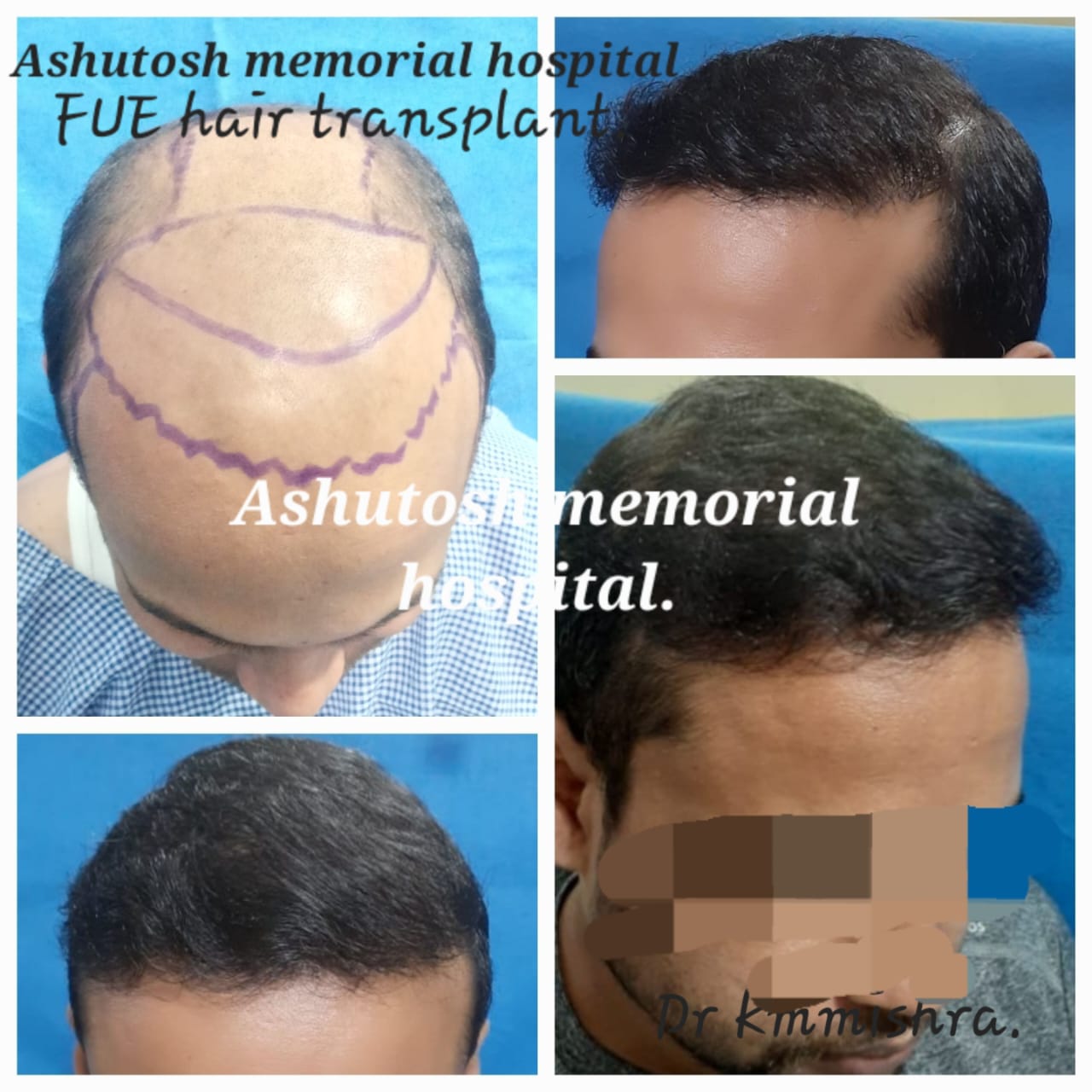 Fue hair transplant