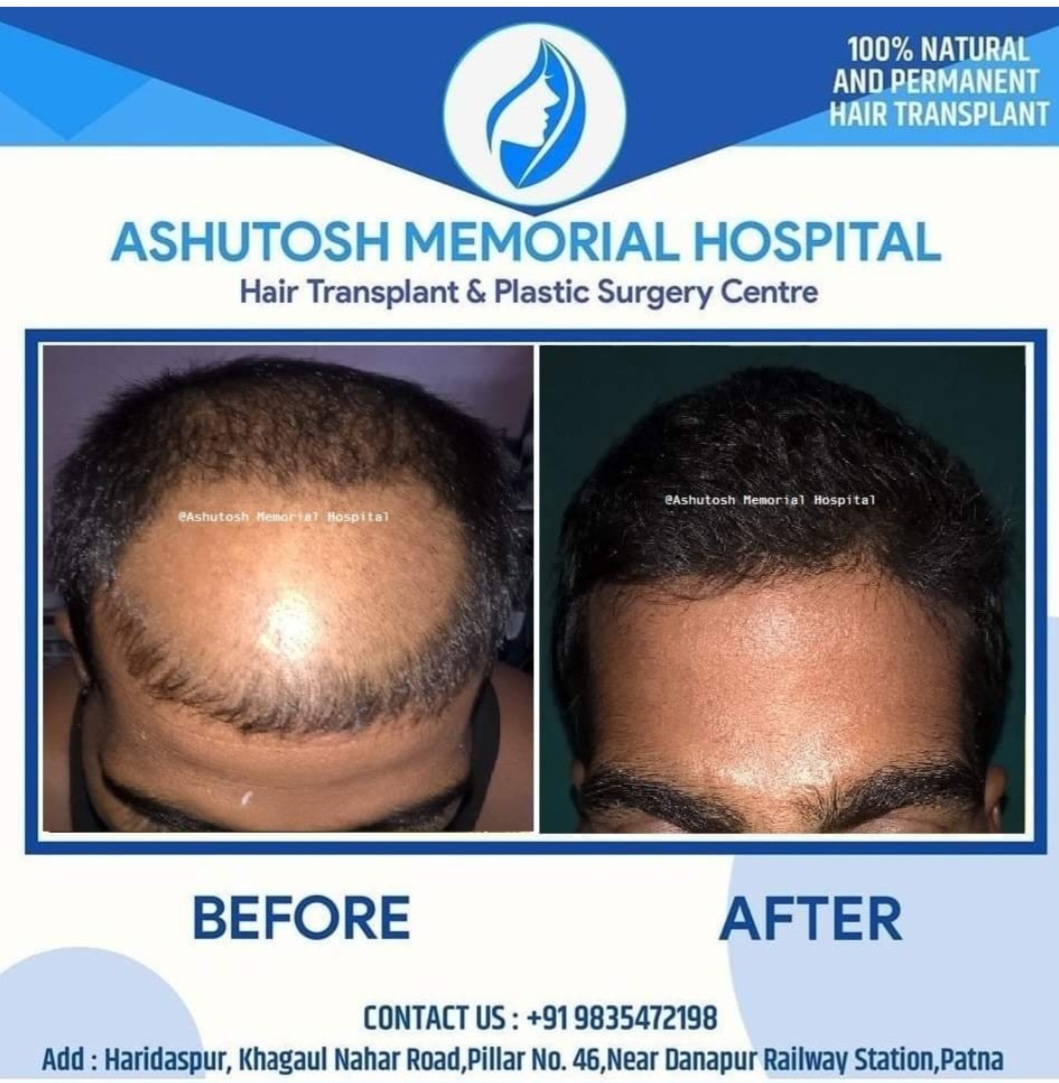 Fue transplant