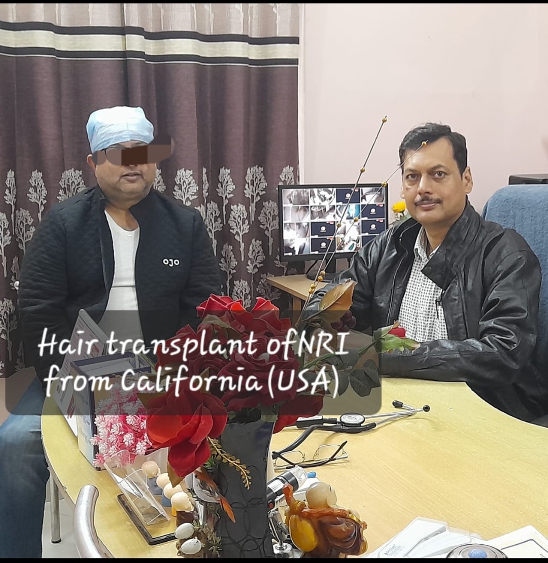 Fue hair transplant