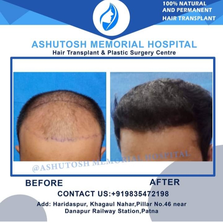 Fue hair transplant