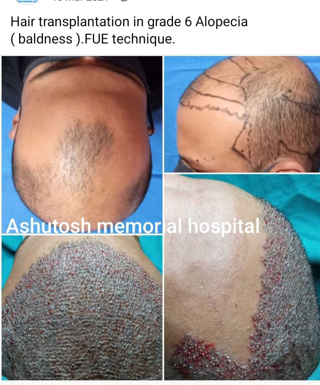 Fue hair transplant