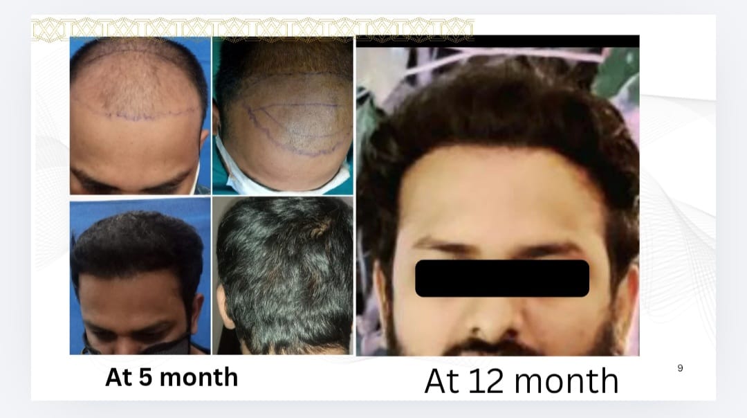 Fue hair transplant