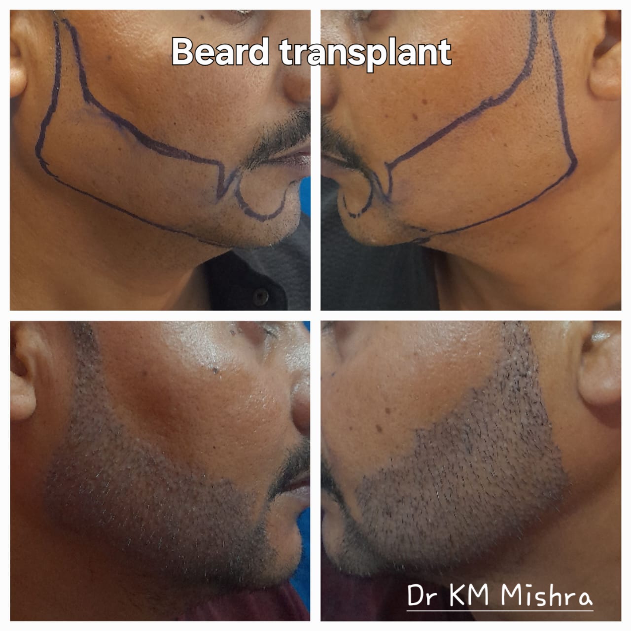 Fue transplant