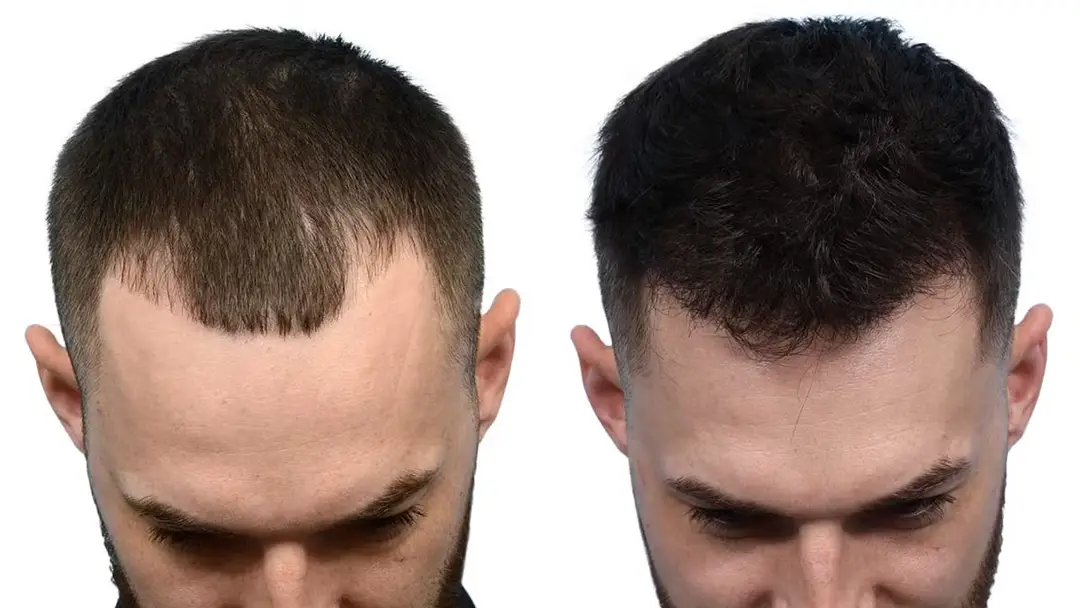 Hair Transplant Patna