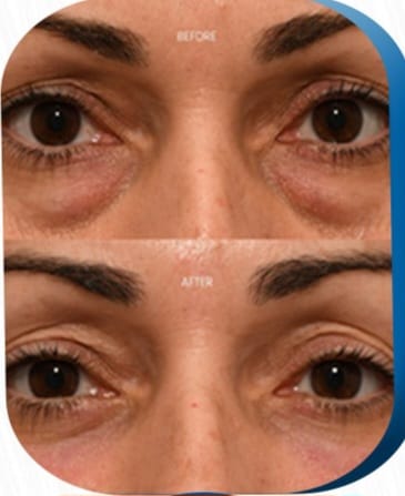 Blepharoplasty