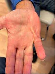 Burn & Post-Burn Contracture Treatment
