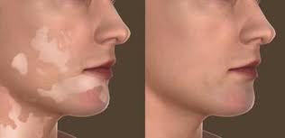 Facial Rejuvenation & Vitiligo Surgery