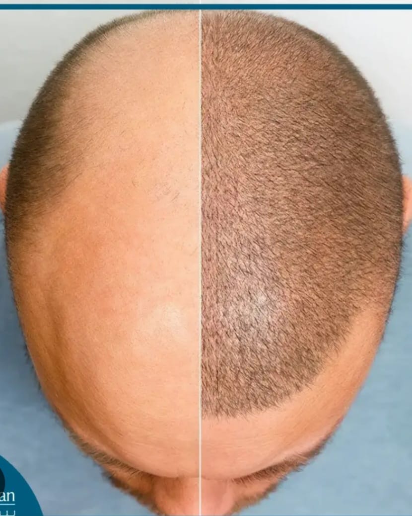 FUE Hair Transplant