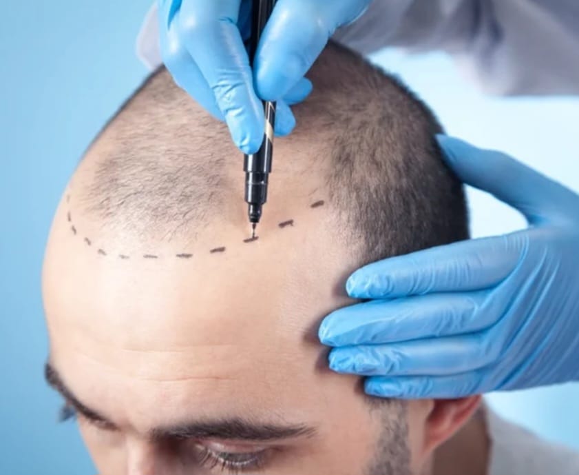 FUT Hair Transplant