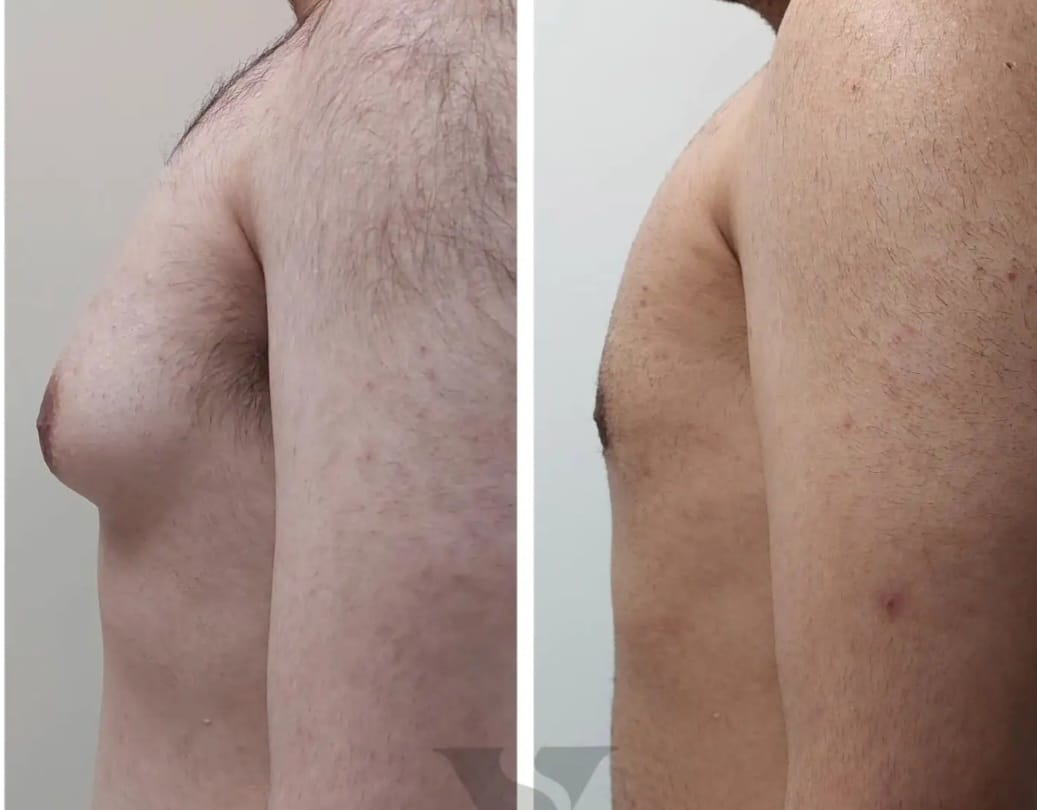 Gynecomastia Male Breast Surgery