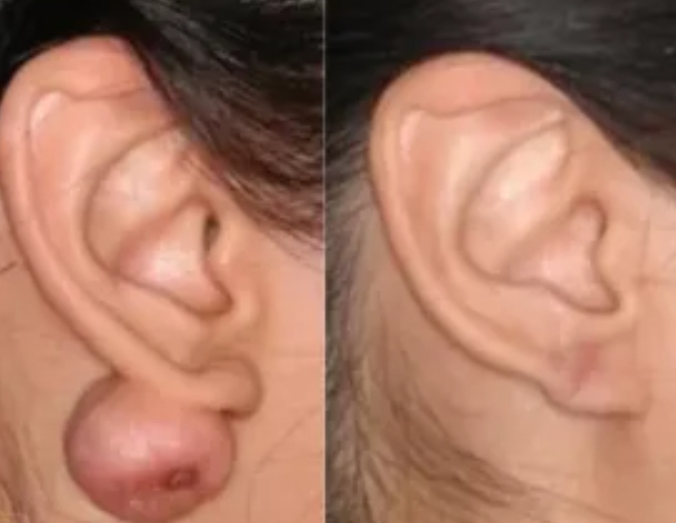 Keloid Treatment