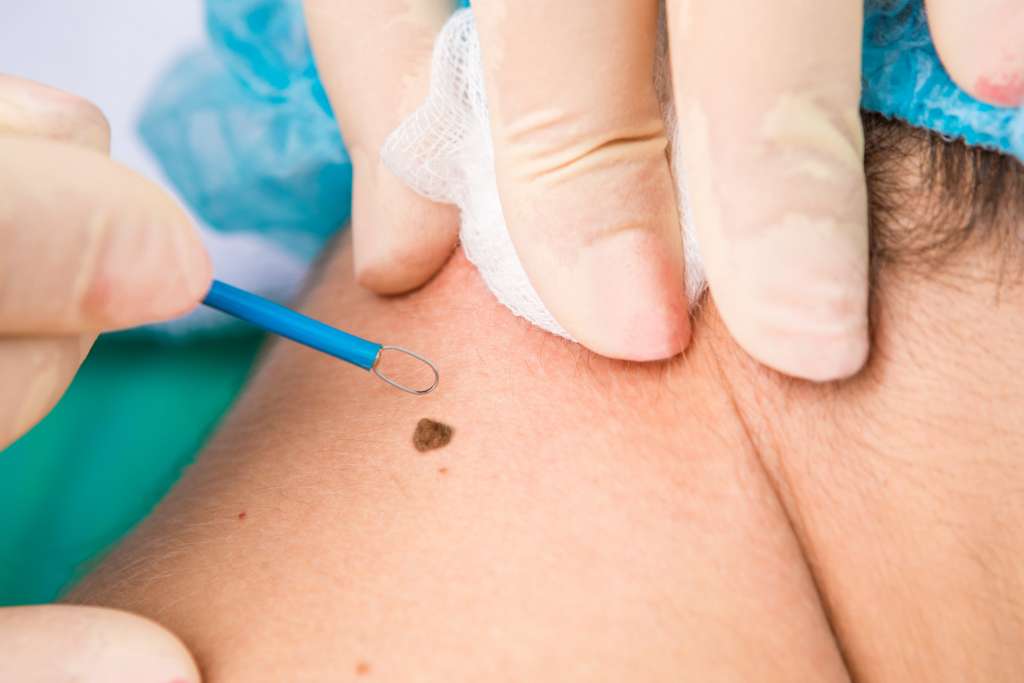 Mole & Hyperpigmented Lesions Surgery