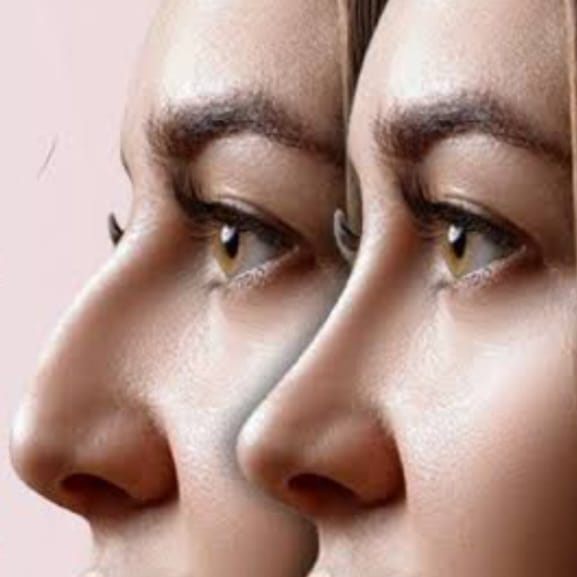 Rhinoplasty