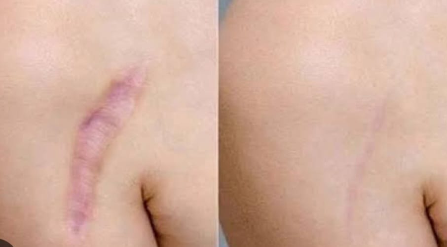 Hair Transplantation in Scars