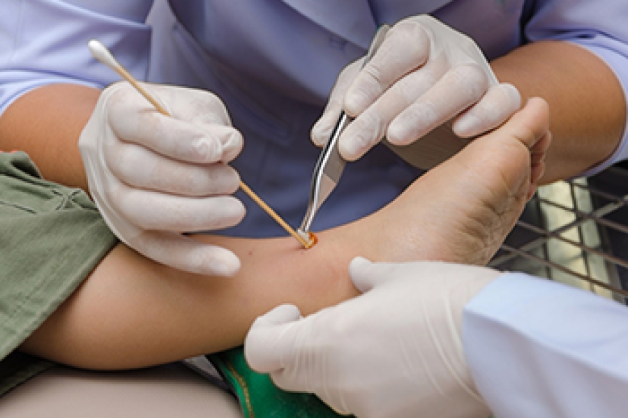 Chronic Wound Diabetic Foot Bed Sore Surgery