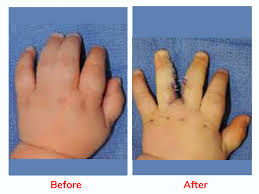 Hand & Finger Surgery Syndactyly