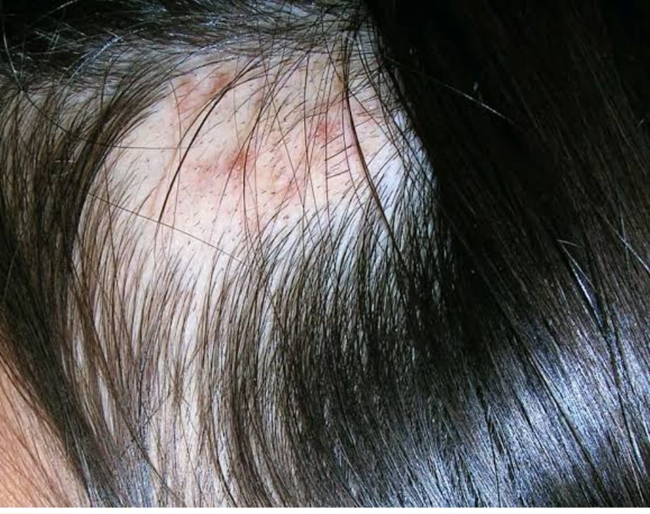 Trichotillomania Treatment